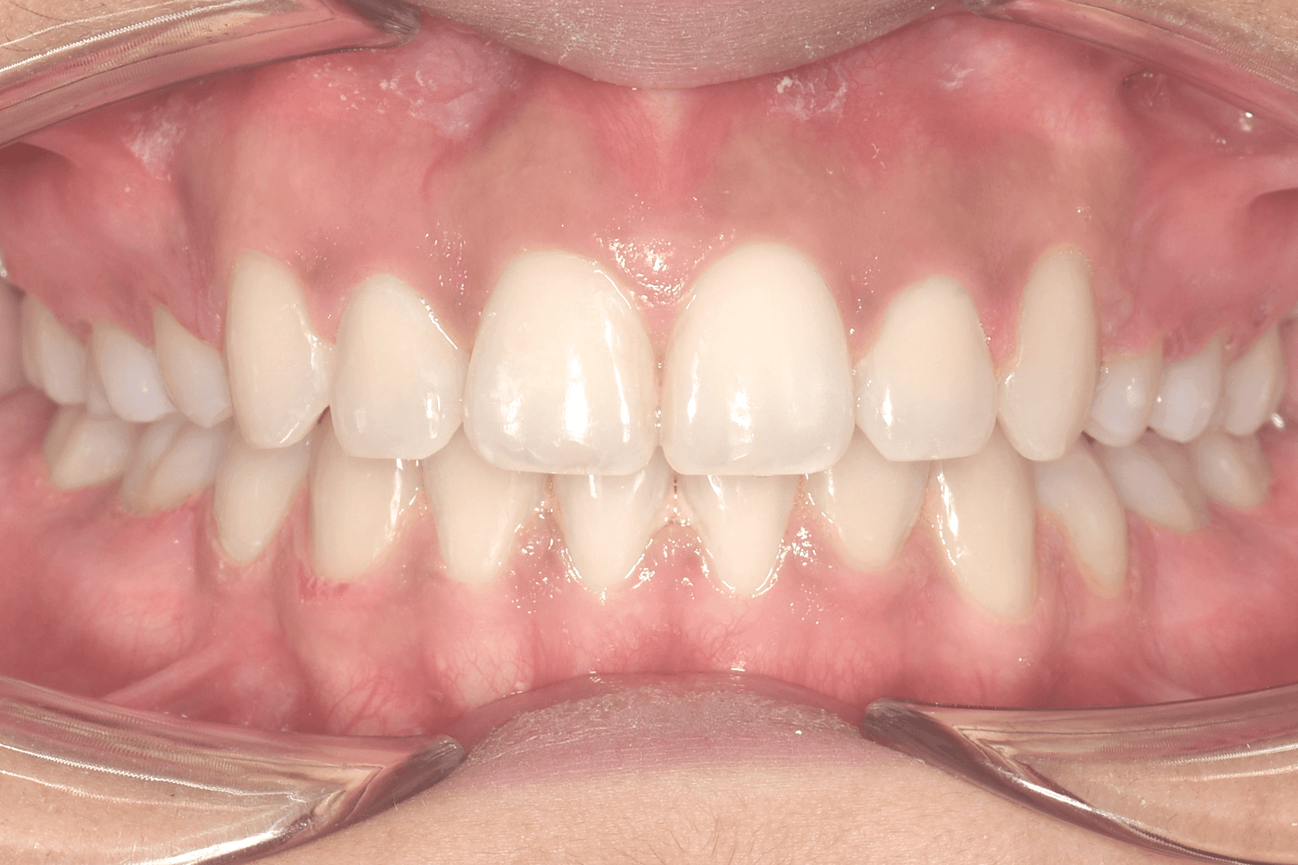 After orthodontic treatment result