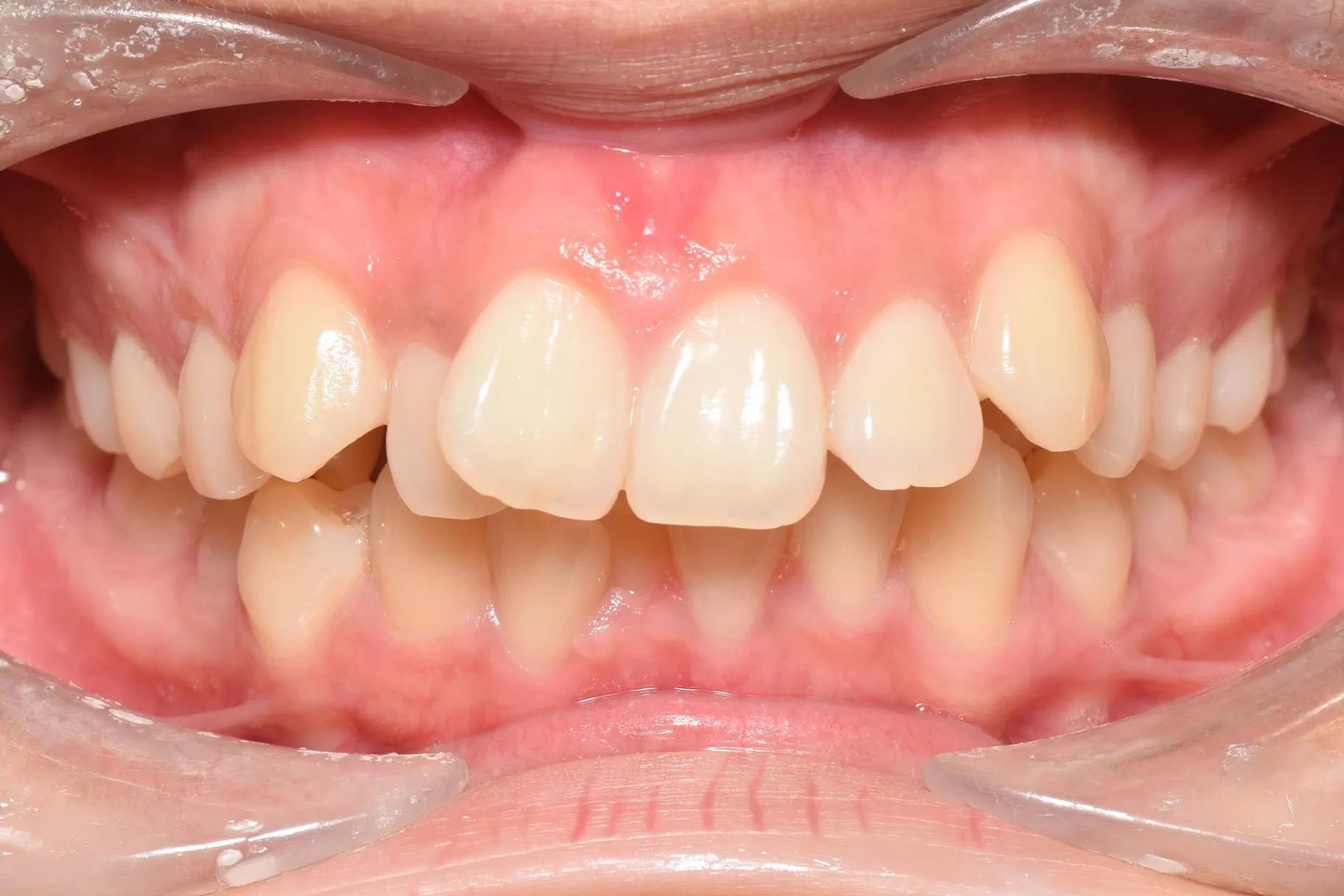 Before orthodontic treatment