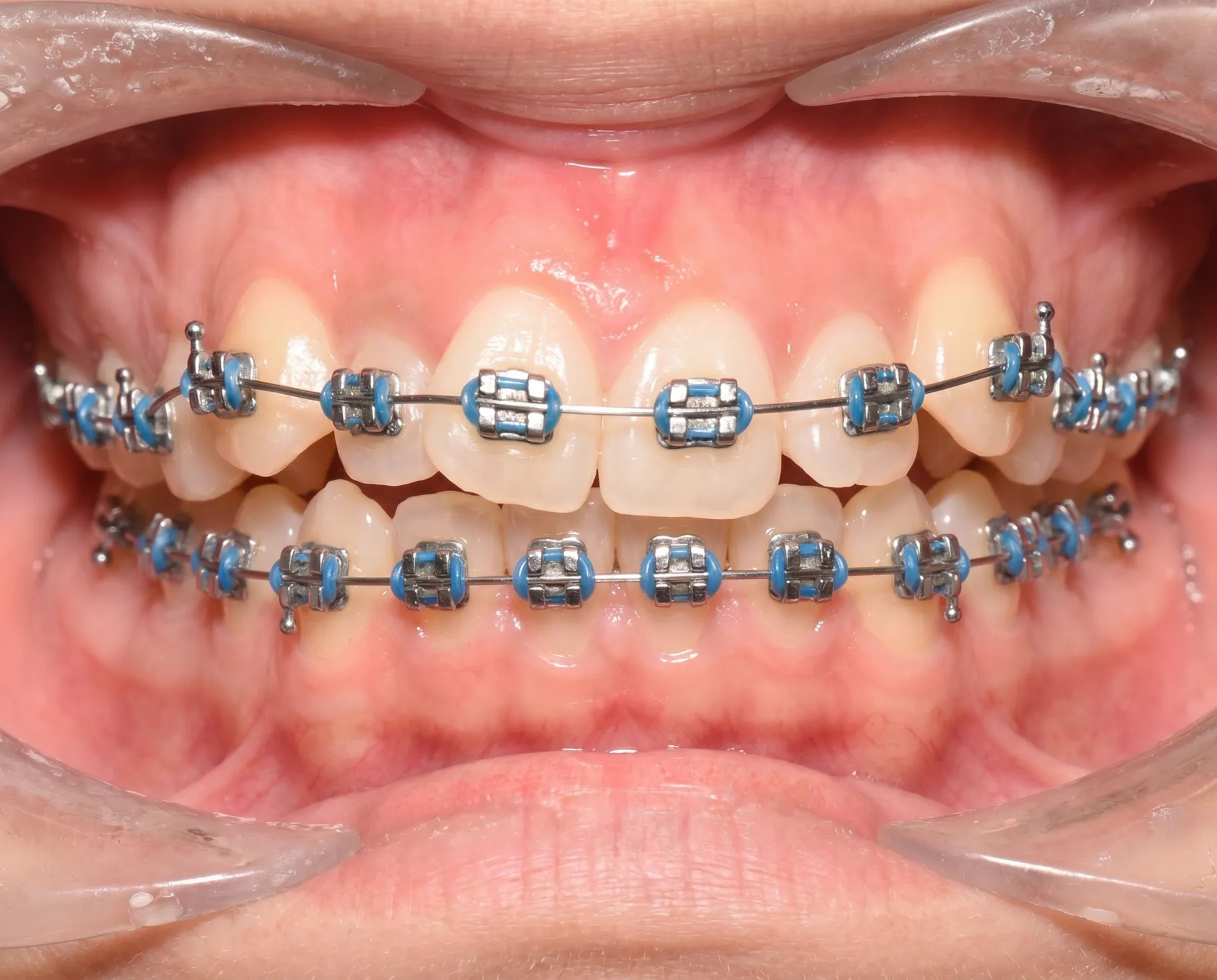 Before orthodontic treatment