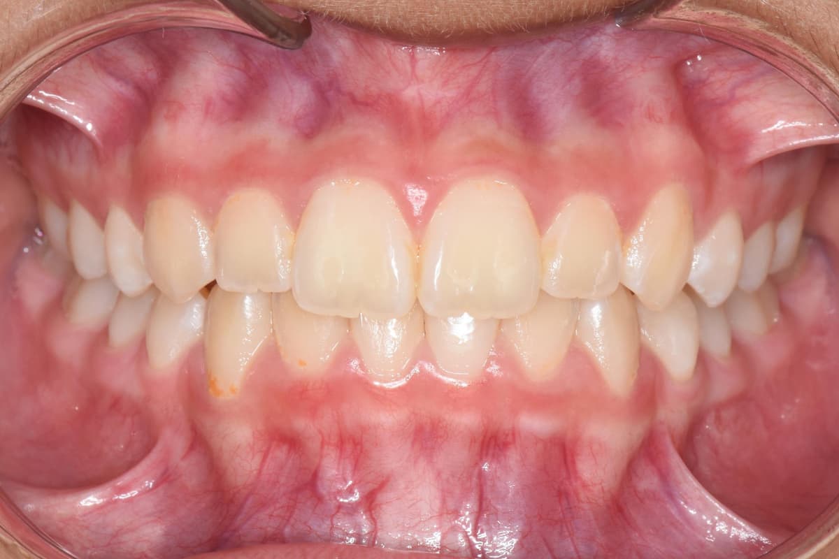 After Adult Tooth Eruption