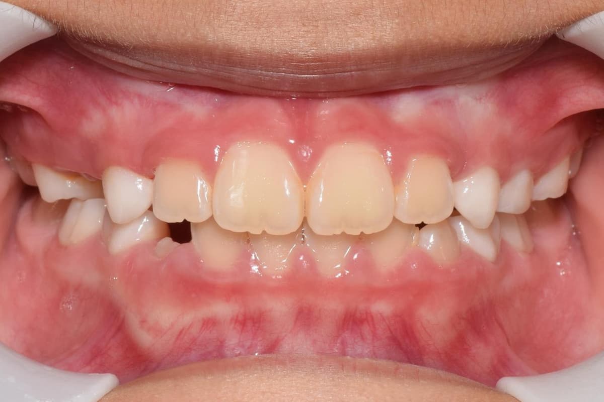After Early Treatment