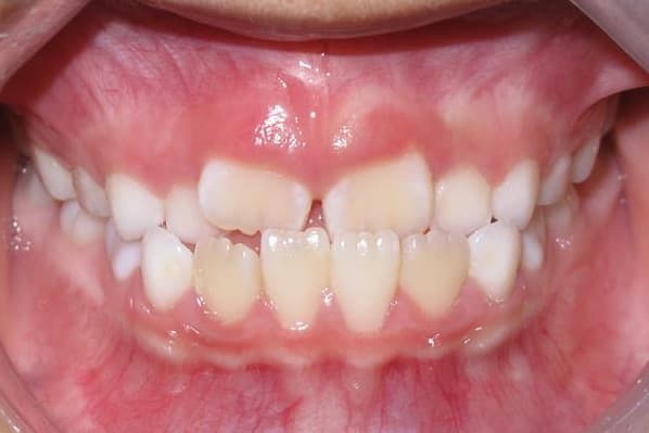 Before Early Treatment