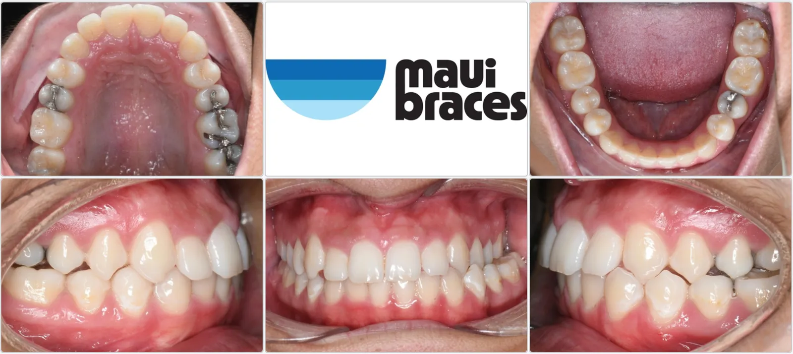 Upper and lower dental arches and bite — Maui Braces case photos