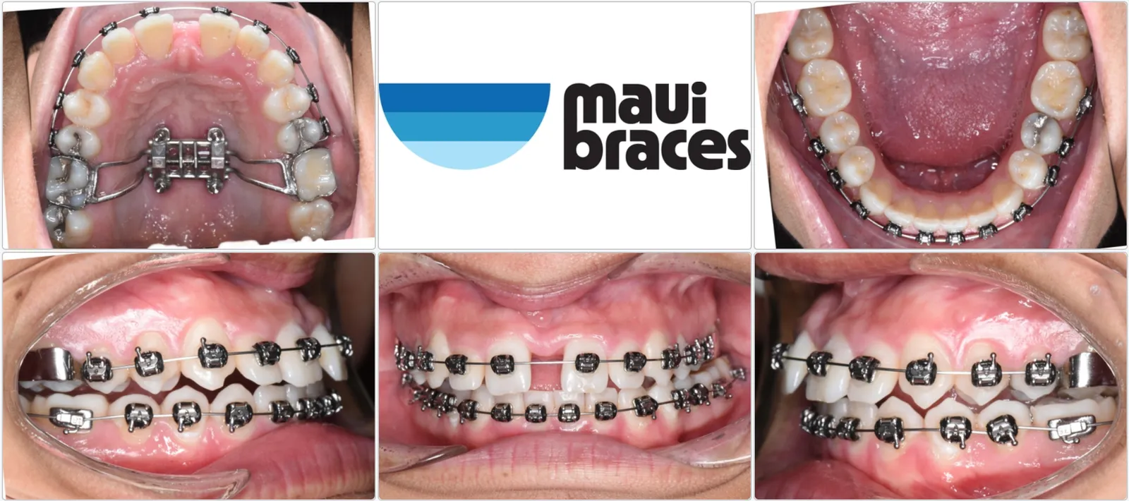 Upper palate with a palatal expander appliance and braces — Maui Braces