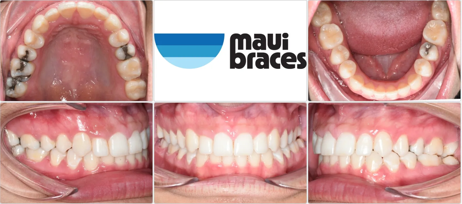 Aligned upper and lower dental arches and bite — Maui Braces case photos