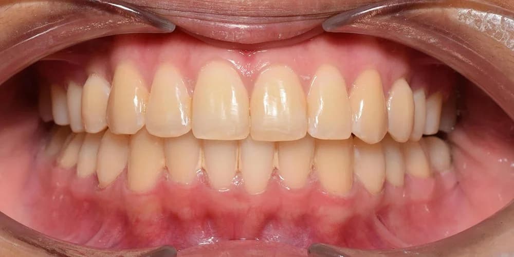 Adults case JM after treatment