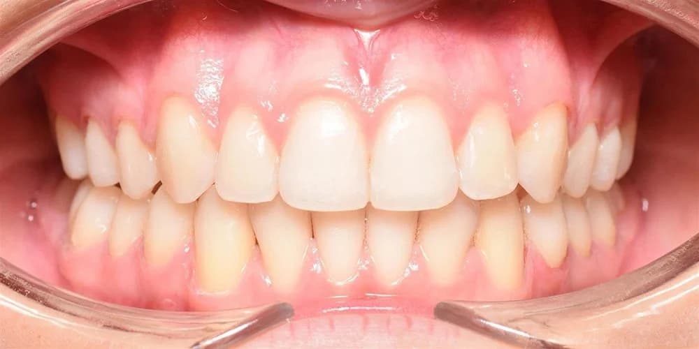 Aligners case ZG after treatment