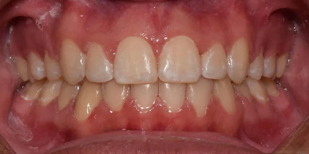 Teens case AA after treatment